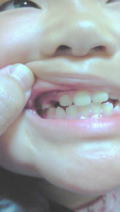 歯.JPG